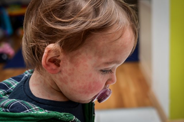 Close up of a white, brown-haired toddler in profile with a measles rash on their face and neck. 