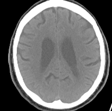 first telestroke brain scan at PeaceHealth Sacred Heart