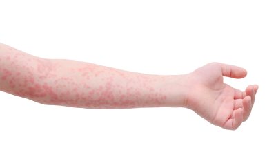 An arm pocked with measles