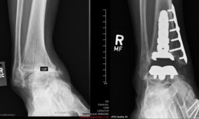 Before and after x-rays of Stephen Winn's ankle