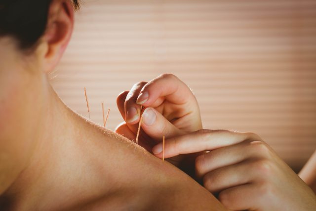 Close-up of an acupuncturist treating a patient's bare shoulder