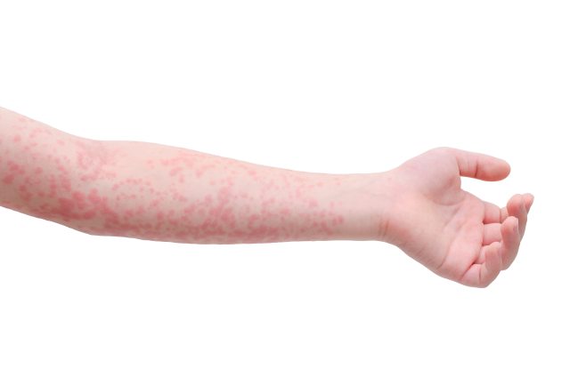 An arm pocked with measles