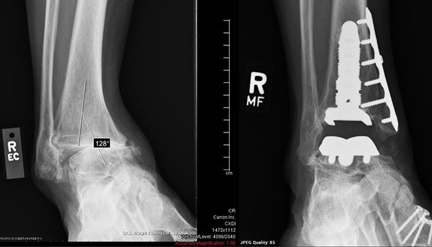 Before and after x-rays of Stephen Winn's ankle